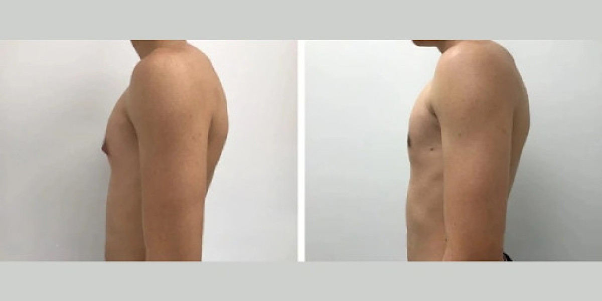 Preparing for a Beach Holiday in Dubai After Gynecomastia Surgery