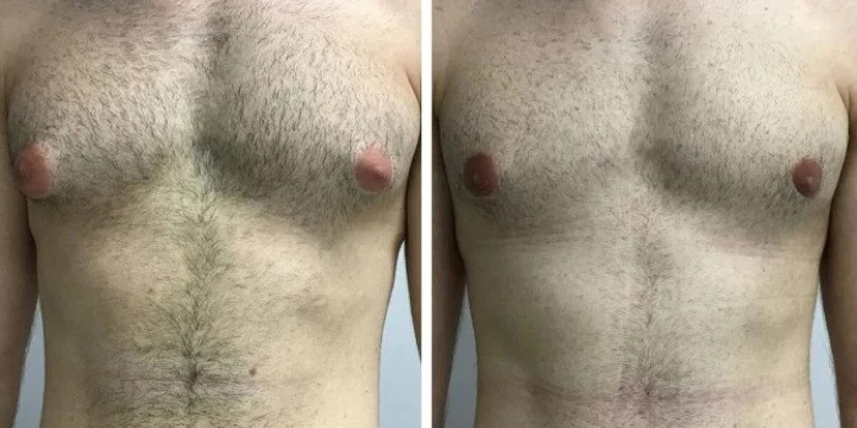International Patients Seeking Gynecomastia in Dubai: A Travel Guide
