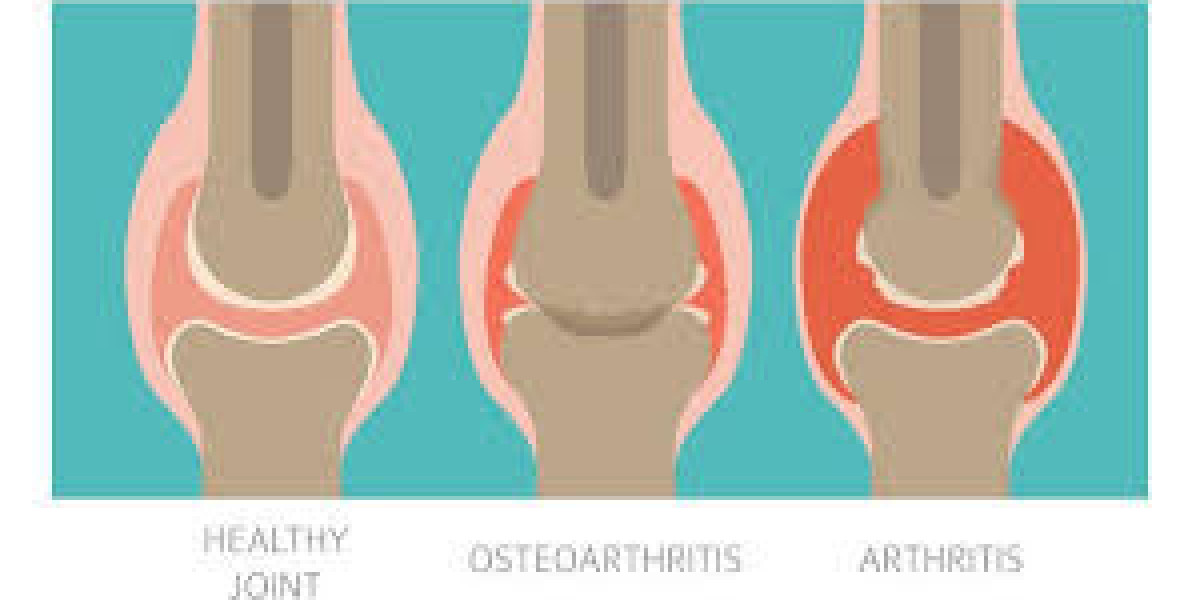 Living with Osteoarthritis: What You Need to Know