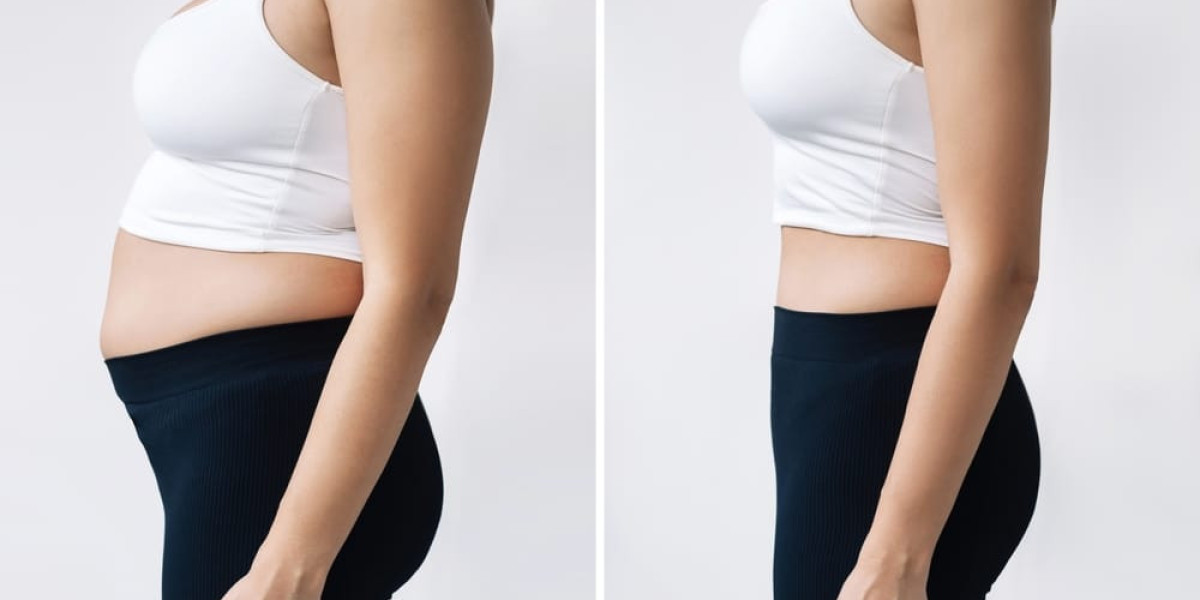 Fat Reduction Treatments in Islamabad for Neck Fat